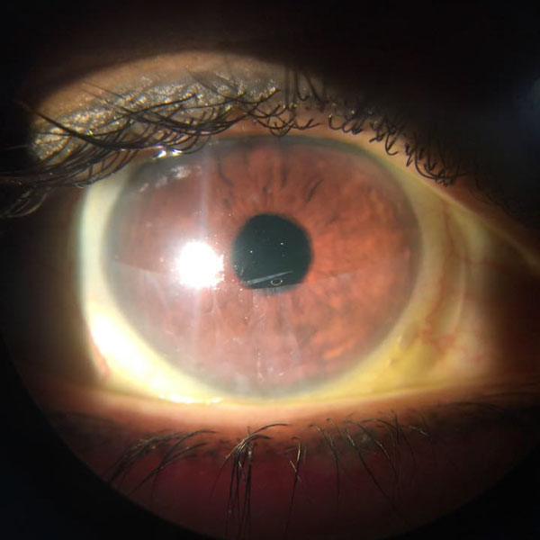 Case Study Bilateral Exposure Keratopathy Ophthalogix