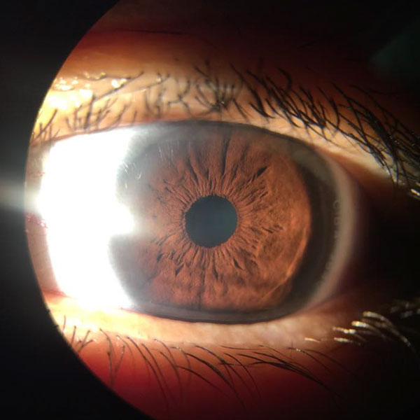 Case Study Bilateral Exposure Keratopathy Ophthalogix