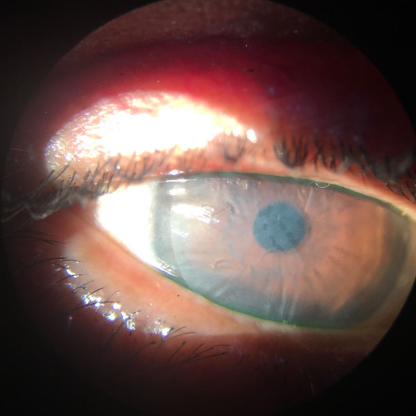 Case Study Epithelial Keratitis Ophthalogix