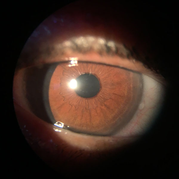 Case Study Epithelial Keratitis Ophthalogix