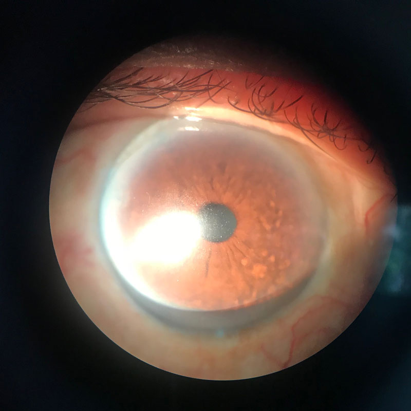 Case Study Exposure Keratopathy Secondary To Chronic Dry Eye Ophthalogix