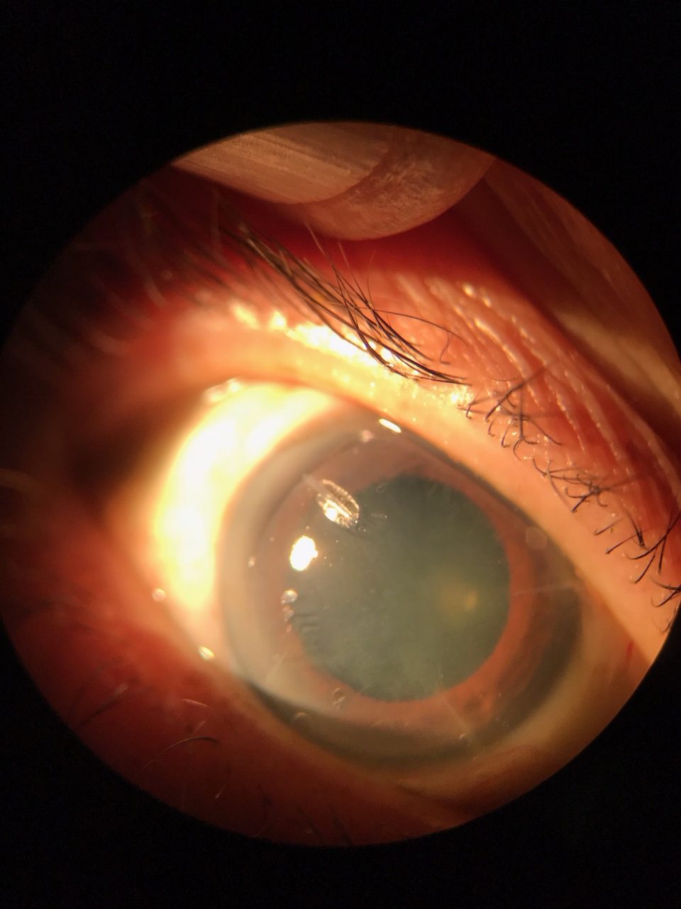 Exposure Keratopathy and Chronic Dry Eye - Ophthalogix